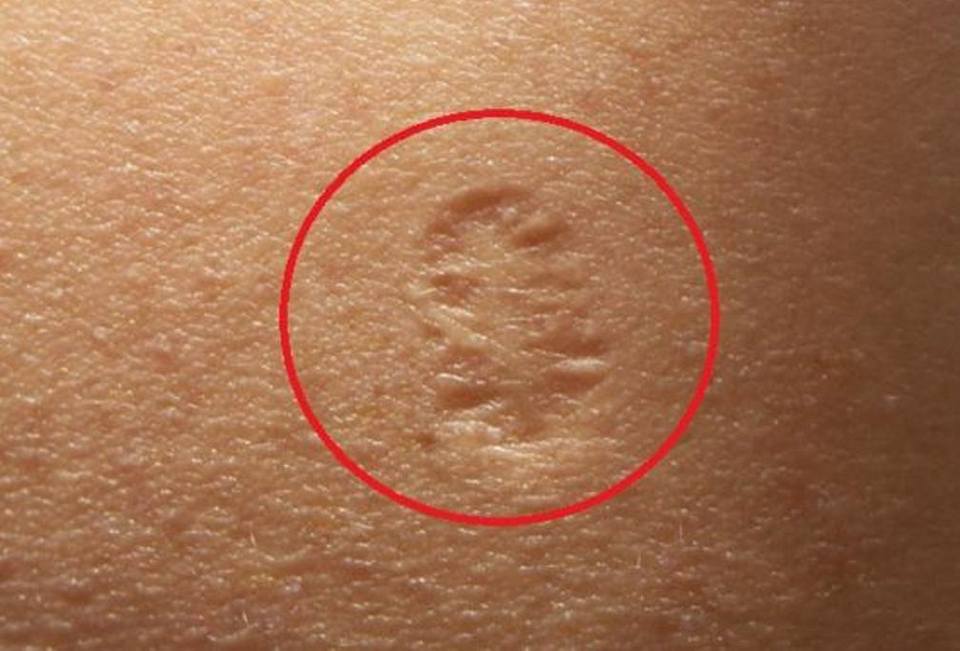Image result for smallpox vaccine scar